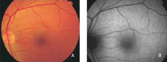 Fundus Autofluorescence In Age Related Macular Degeneration